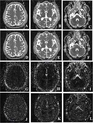 Intravoxel Incoherent Motion Magnetic Resonance Imaging Used in Preoperative Screening of High-Risk Patients With Moyamoya Disease Who May Develop Postoperative Cerebral Hyperperfusion Syndrome